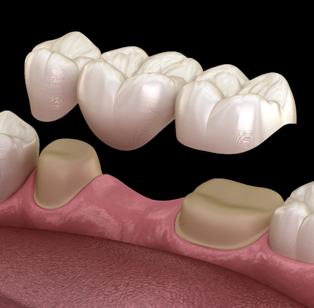 Dental crowns