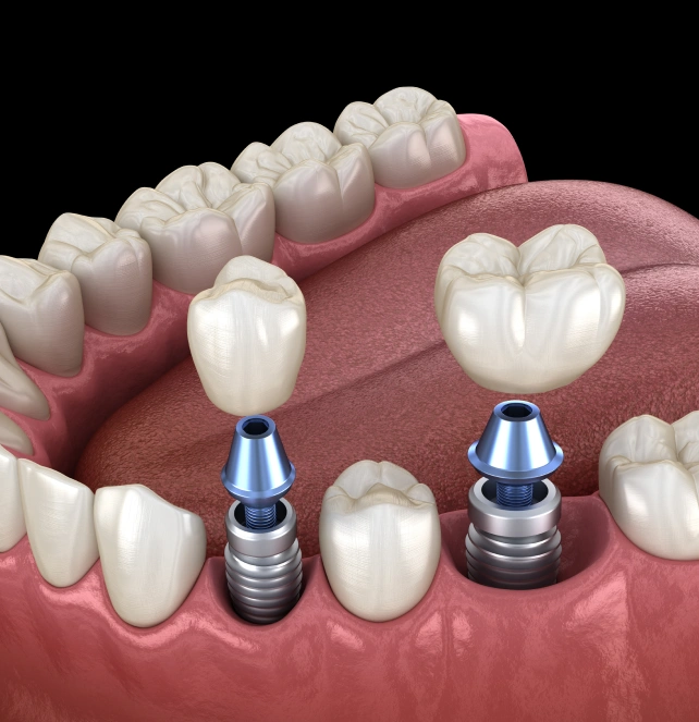 Dental implants